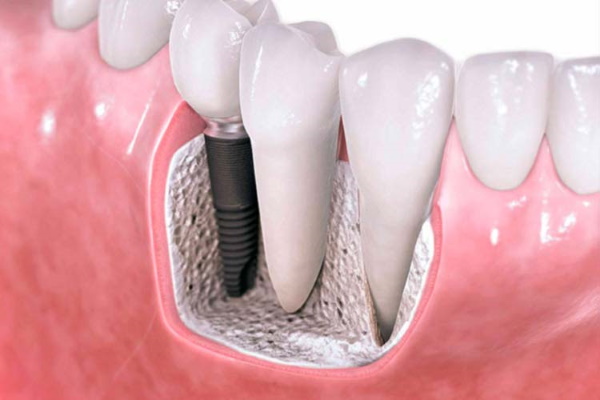 dentalcroatia_implants_abroad - コピー